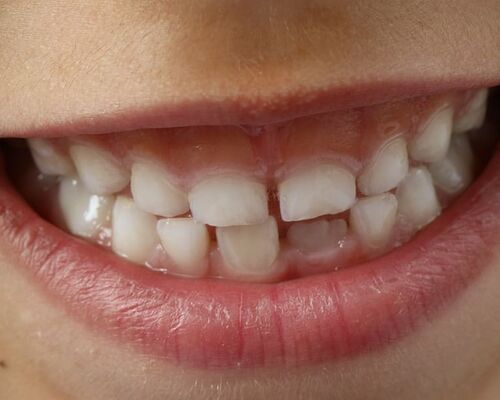 teeth-child-smile-child-dental
